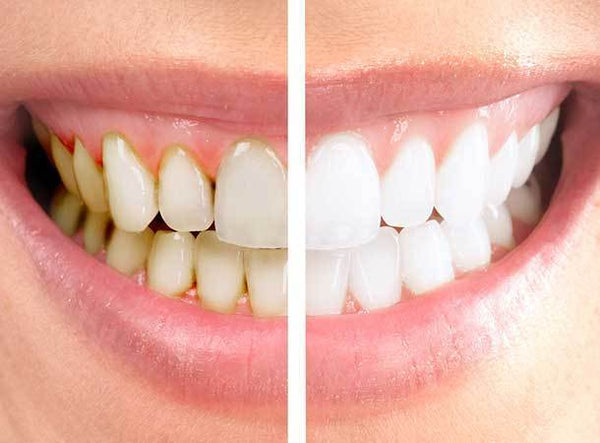 What Should You Expect After Your Teeth Whitening Procedure?